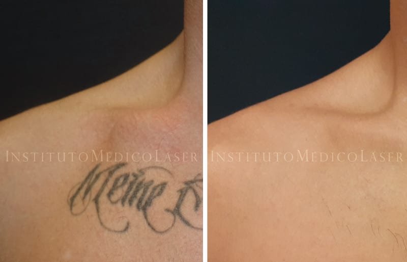 antes y despues de la eliminacion del tatuaje