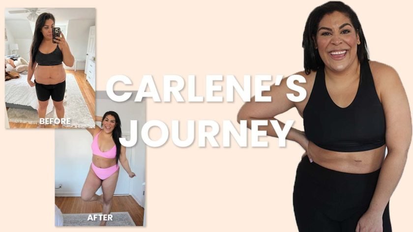 antes y despues de procedimiento de sono bello