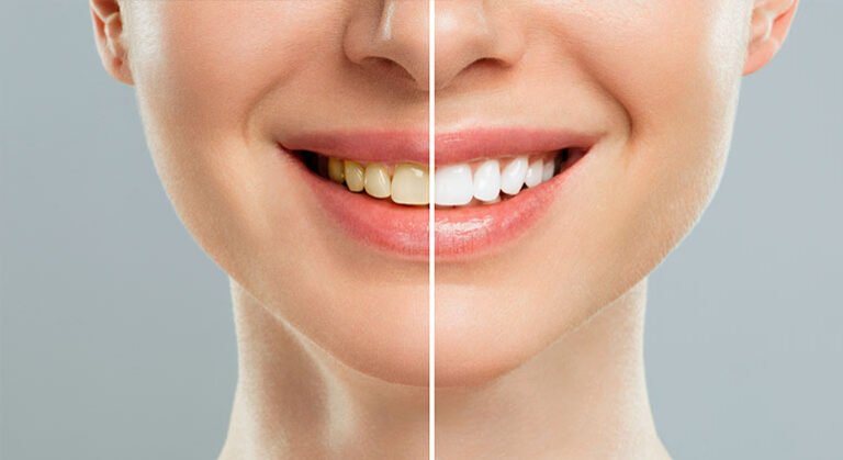 Smile Direct Club Before and After: Transformations You Need to See