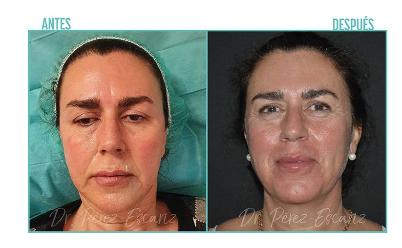 antes y despues de tratamiento con radiofrecuencia