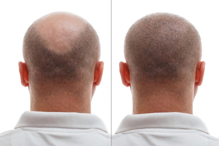 Natural Transplants Hair Restoration Clinic: Expert Hair Solutions