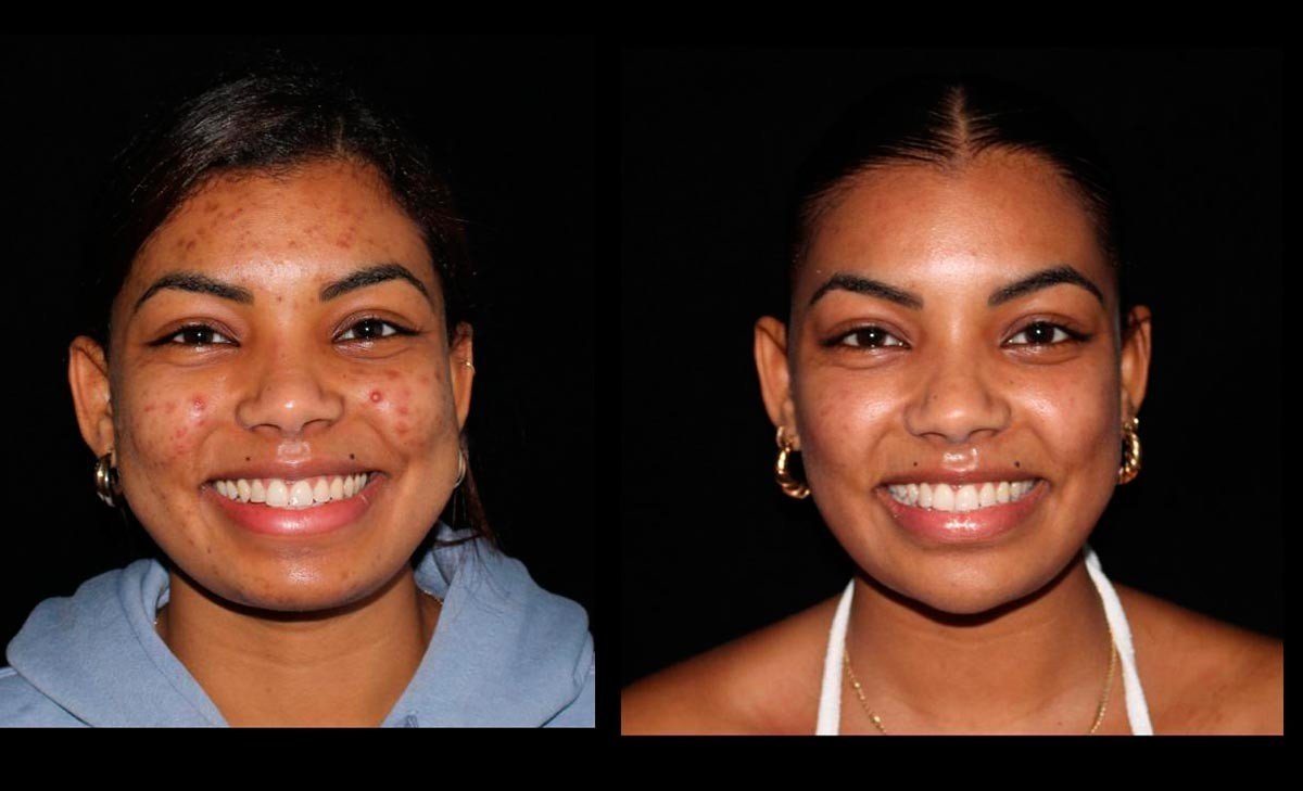 antes y despues de una cirugia estetica