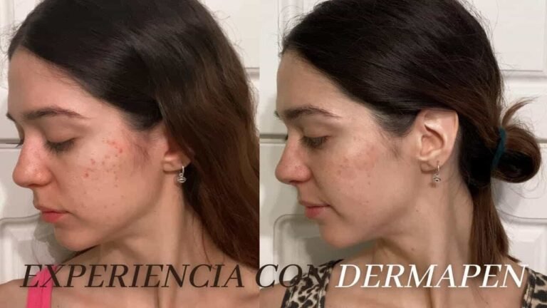 Dr Pen Before and After: Stunning Transformation Results