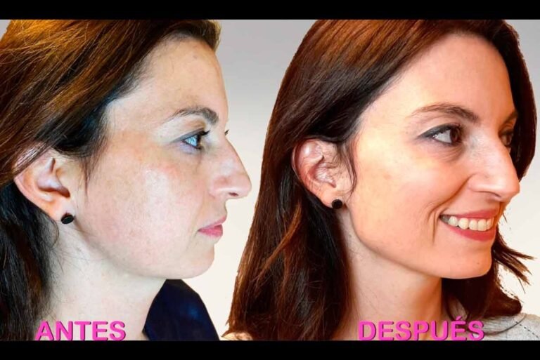Musely Spot Peel Before and After: Stunning Results Revealed