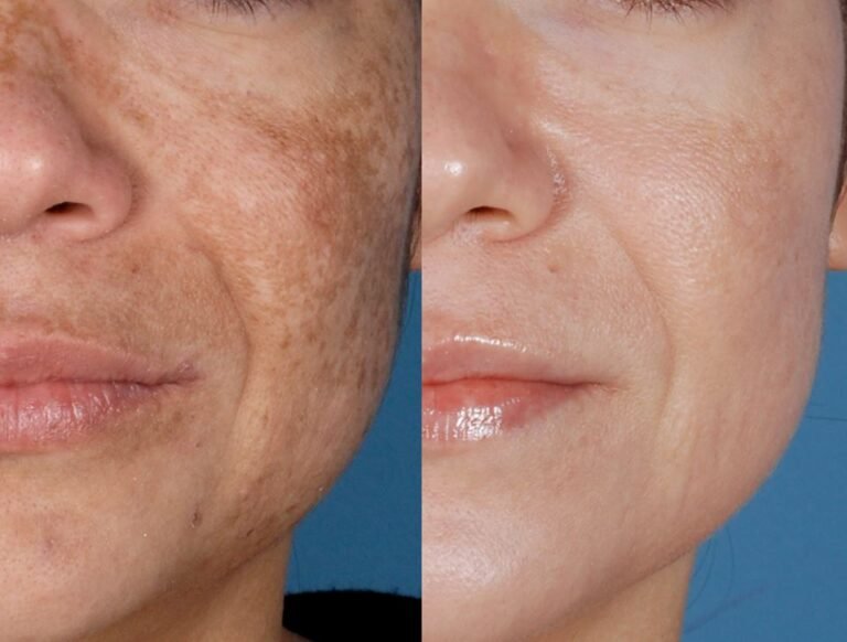 Zo Skin Before and After: Transformative Results