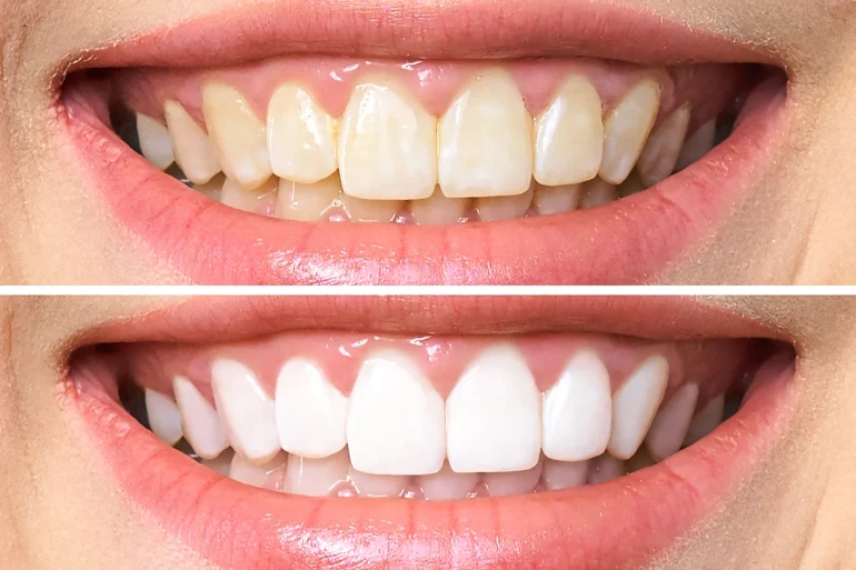 dientes blancos brillantes y saludables naturalmente