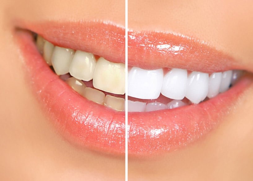 dientes mas blancos con sonrisa radiante
