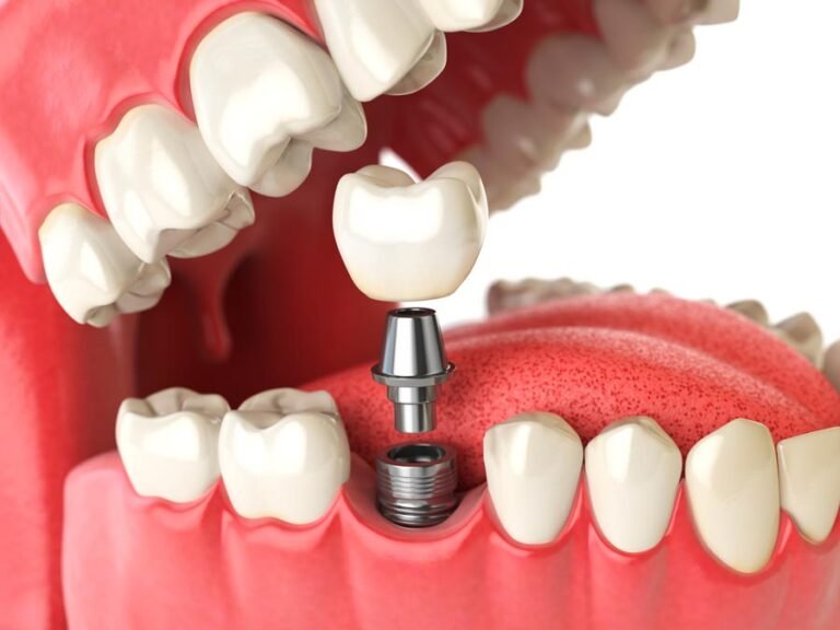 Clear Choice Dental Implants Costs: What to Expect