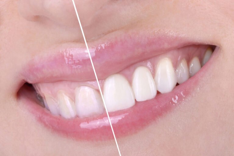 Hi Smile Teeth Whitening Kit: Brighter Smile in Days