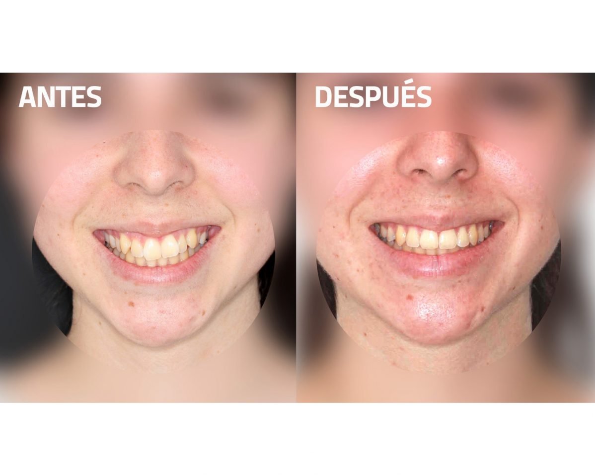 sonrisa perfecta despues de tratamiento ortodoncico