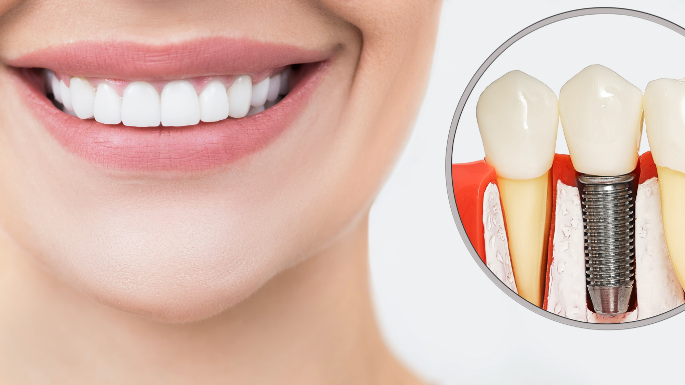 sonrisa radiante despues de implantes dentales 1