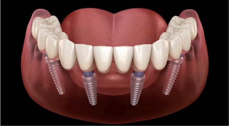 Cost for Clear Choice Dental Implants: Affordable Options